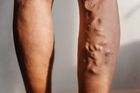 Křečové žíly trápí ženy i muže. Prevencí je žilní gymnastika