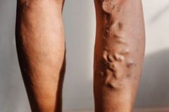 Křečové žíly trápí ženy i muže. Prevencí je žilní gymnastika
